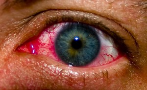 Qu&rsquo;est ce que l&rsquo;allergie oculaire?