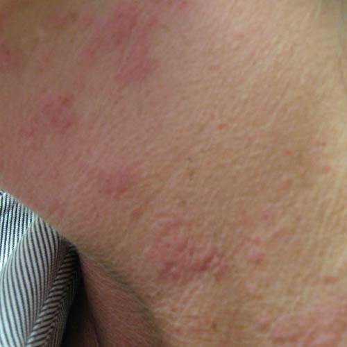 Les causes de l'urticiare- allergie cutanée