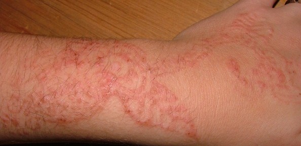Allergie au Tatouage-henné