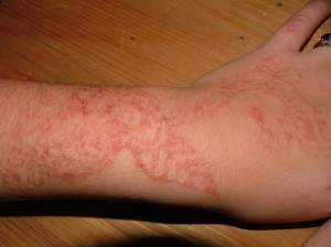 Allergie au Tatouage-henné