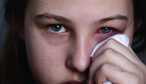 Les allergies des yeux : la conjonctivite